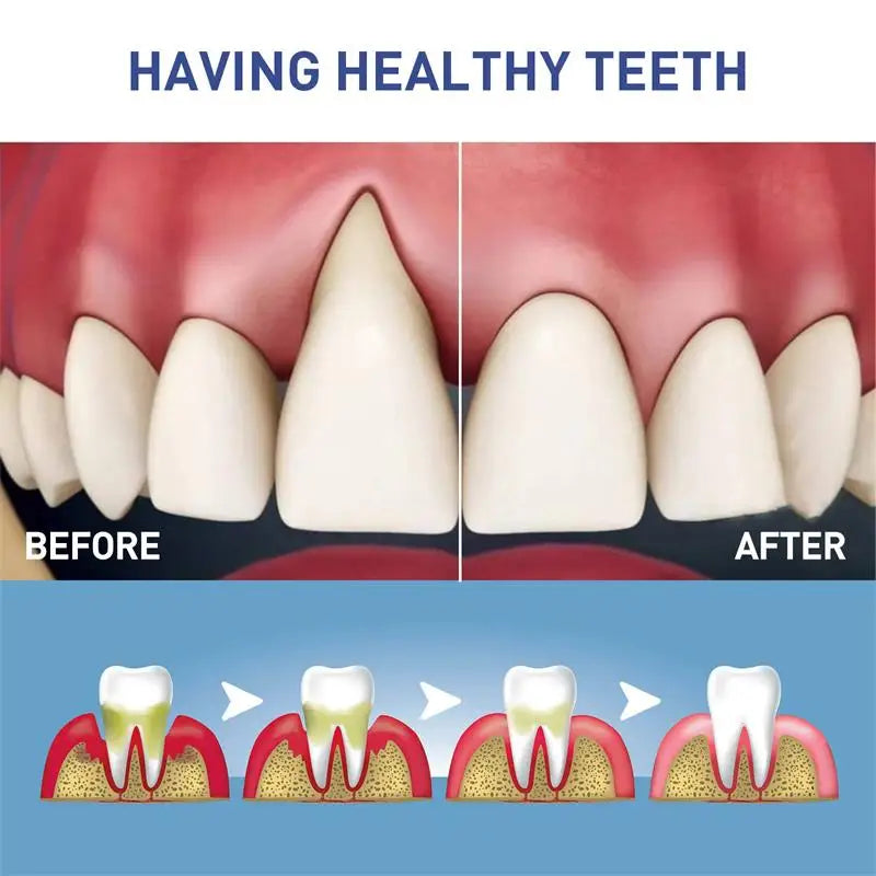 Gum Instant Treatment Gel Relieve Gingival Recession Swelling Pain Clean Plaque Stains Whiten Teeth Anti Gingival Inflammation