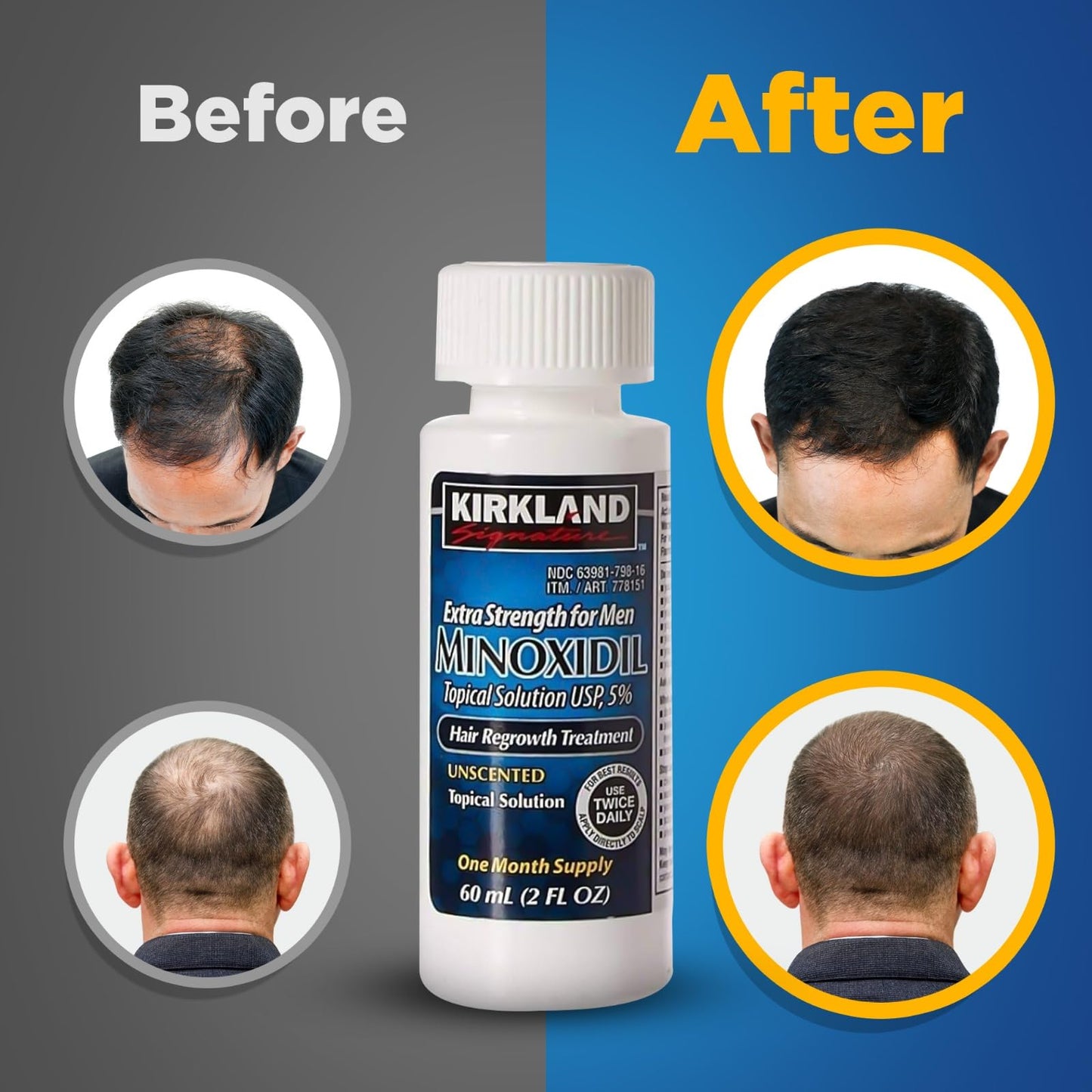 Minoxidil-5% Extra Strength Hair Regrowth for Men, 6 Month Supply