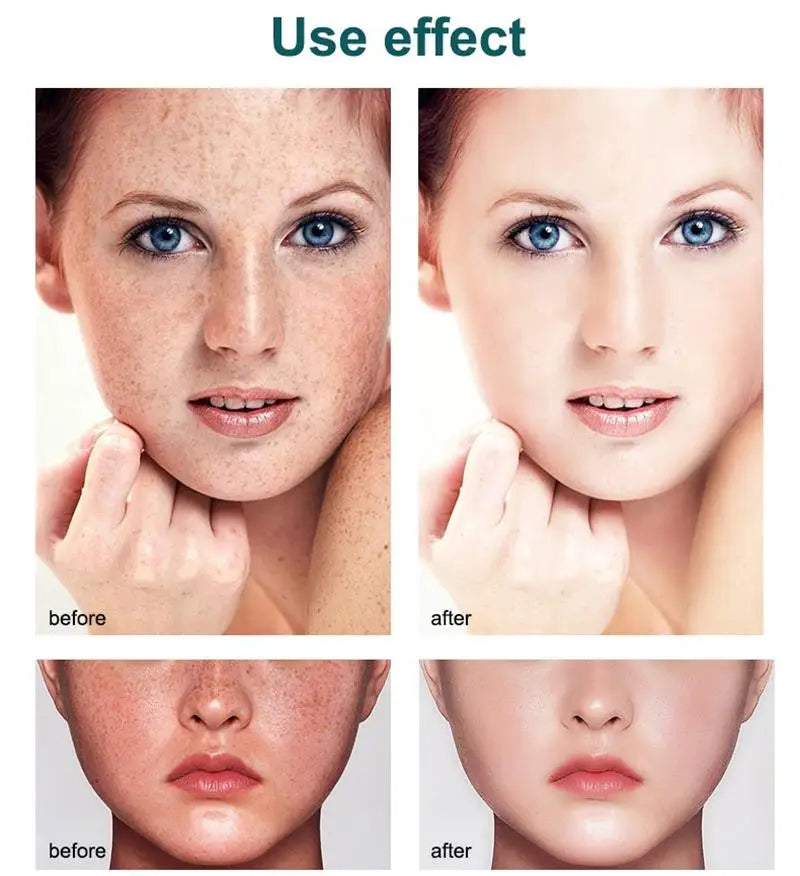 Powerful Spot-removing Whiten Cream Brighten Skin Fast Eliminates Melanin Pigmentation Melasma Dark Spots Moisturize Beauty Gel