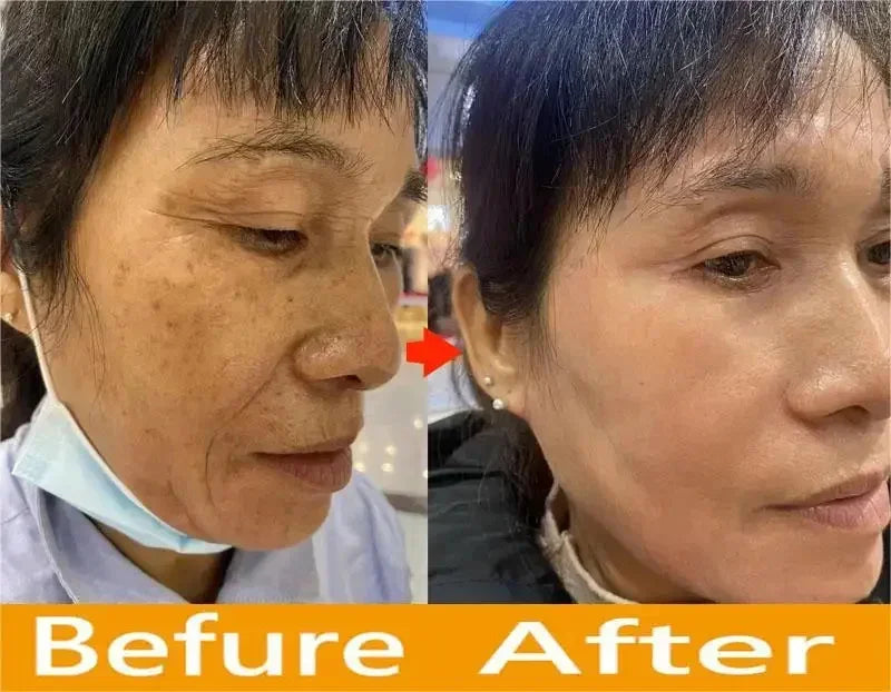Vitamin C Whitening Freckles Serum Cream Remove Dark Spots Fade Melasma Lighten Melanin Pigment Bleaching Moisturizing Skin Care