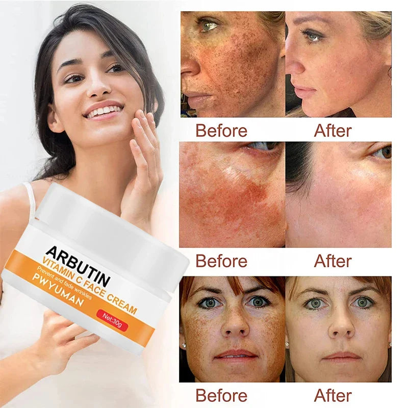 Vitamin C Whitening Freckles Serum Cream Remove Dark Spots Fade Melasma Lighten Melanin Pigment Bleaching Moisturizing Skin Care