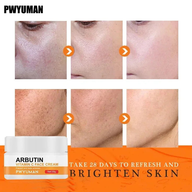 Vitamin C Whitening Freckles Serum Cream Remove Dark Spots Fade Melasma Lighten Melanin Pigment Bleaching Moisturizing Skin Care