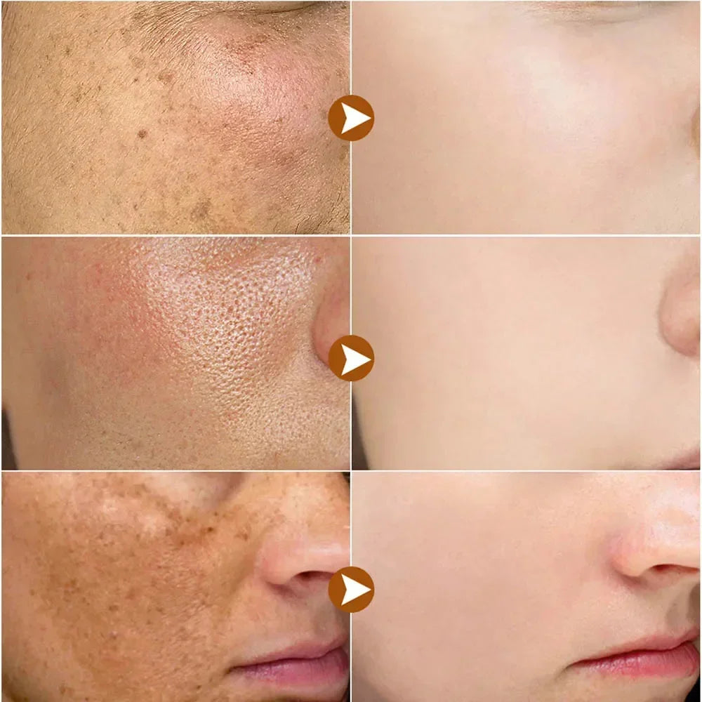 Vitamin C Whitening Freckles Serum Cream Remove Dark Spots Fade Melasma Lighten Melanin Pigment Bleaching Moisturizing Skin Care