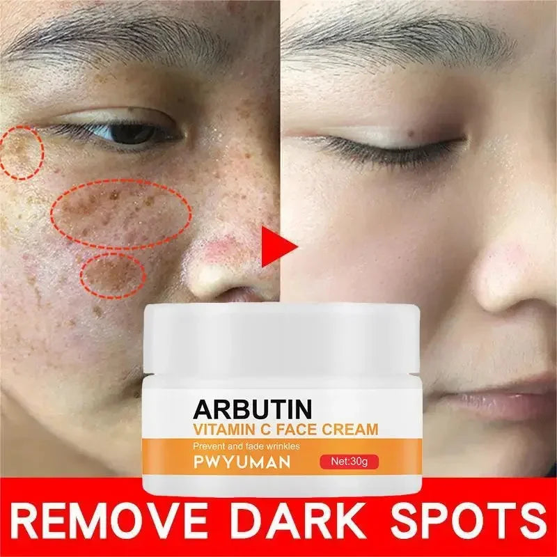 Vitamin C Whitening Freckles Serum Cream Remove Dark Spots Fade Melasma Lighten Melanin Pigment Bleaching Moisturizing Skin Care