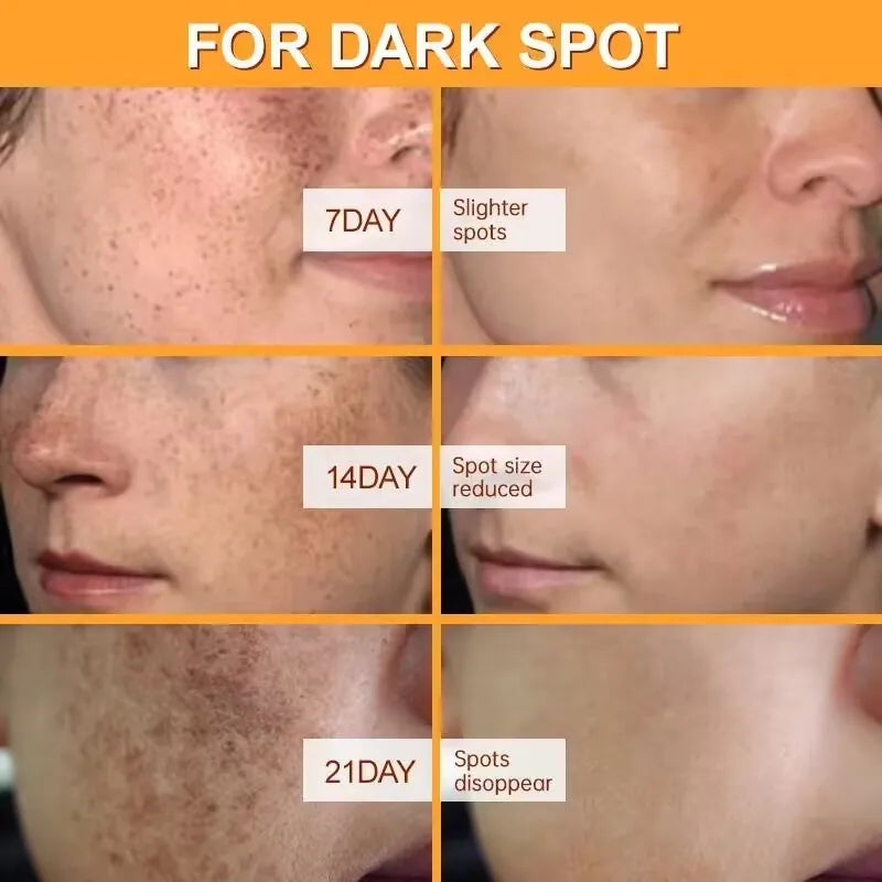 Vitamin C Whitening Freckles Serum Cream Remove Dark Spots Fade Melasma Lighten Melanin Pigment Bleaching Moisturizing Skin Care