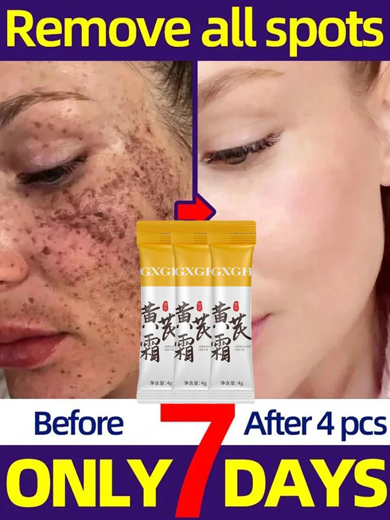 Powerful Spot-removing Whiten Cream Brighten Skin Fast Eliminates Melanin Pigmentation Melasma Dark Spots Moisturize Beauty Gel