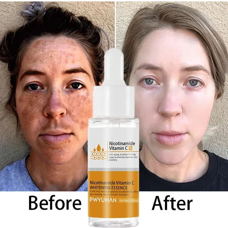 Vitamin C Whitening Freckles Serum Cream Remove Dark Spots Fade Melasma Lighten Melanin Pigment Bleaching Moisturizing Skin Care