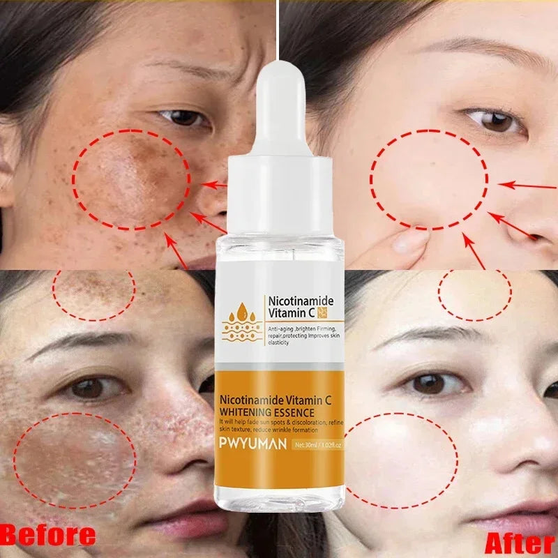 Vitamin C Whitening Freckles Serum Cream Remove Dark Spots Fade Melasma Lighten Melanin Pigment Bleaching Moisturizing Skin Care