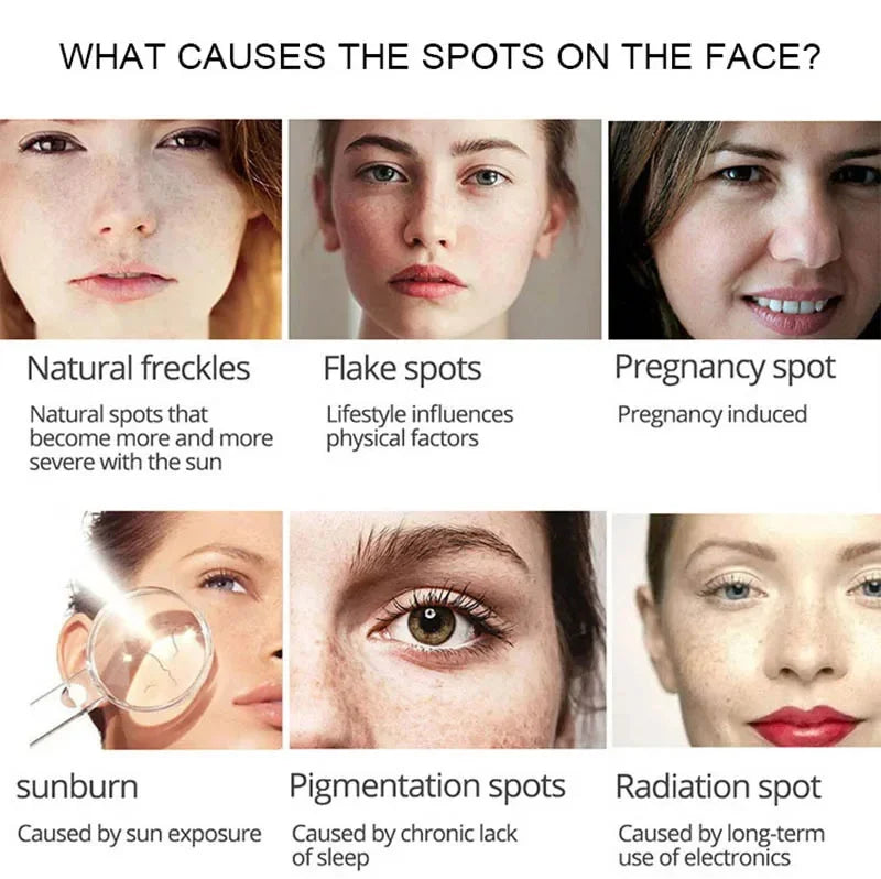 Powerful Spot-removing Whiten Cream Brighten Skin Fast Eliminates Melanin Pigmentation Melasma Dark Spots Moisturize Beauty Gel